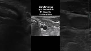 Neck Lymph Nodes  4 ultrasound imaging infection inflammation cases [upl. by Aihsirt]