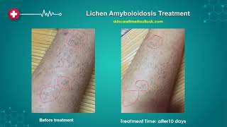 Successfull Lichen Amyloidosis Treatment Lichen Amyloidosis Cure 20192022 [upl. by Inafetse]