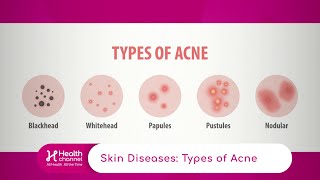 Types of Acne [upl. by Nuri278]