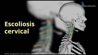 Escoliosis cervical [upl. by Etteval]