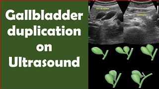 Gallbladder duplication on Ultrasound [upl. by Arsuy]