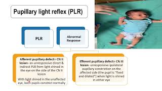 Pupillary Light Reflex  Pediatrics [upl. by Gothurd]