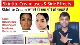 Honest Review of skinlite cream in Hindi  गोरेपन की क्रीम  uses and side effects of skinlite cream [upl. by Ariaec663]