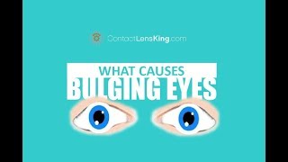 BULGING EYES  Causes Symptoms and Treatment  Exophthalmos Exopthalmia Exorbitsm and Proptosis [upl. by Dub]