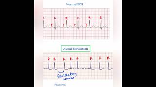 Atrial fibrillation ECG  USMLE Step 1 amp 2 [upl. by Fenwick]