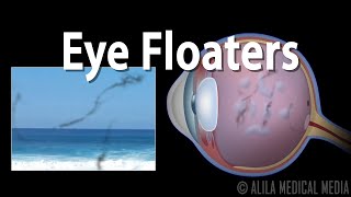 Eye Floaters and Flashes Animation [upl. by Ewald]