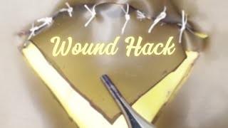 VtoY Plasty A Surgical Wound Hack [upl. by Siron]