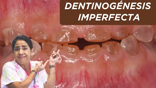 Dentinogénesis imperfecta ¿qué es ¿por qué sucede [upl. by Abehsile]