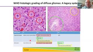 Pathology Grand Rounds  Dr PJ Cimino [upl. by Dougy]