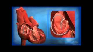 Ablation for AV Node Reentrant Tachycardia AVNRT [upl. by Ahsemac]