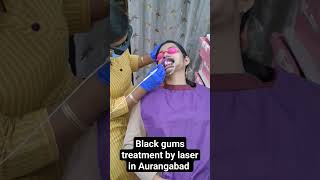 Black gum treatment by laser in Aurangabad gum depigmentation gingival bleaching melanosis treatmen [upl. by Amata]