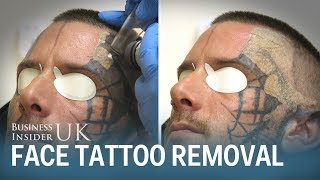 Watch This Man Have His Face Tattoo Removed From Laser Surgery  Business Insider [upl. by Sugihara]