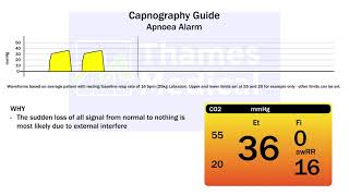 Capnography Waveforms Apnoea Alarm [upl. by Herriott]