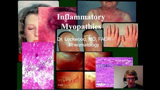 14 Inflammatory Myopathy Dermatomyositis Polymyositis Inclusion Body Myositis and others [upl. by Hinman]