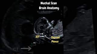 Ultrasound Nuchal Scan Must know Important Brain Anatomy [upl. by Musette563]