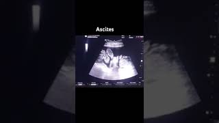 Ultrasound  Ascites Utrasound video [upl. by Nahgrom]