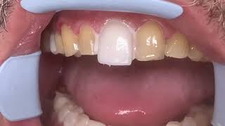 Houston Cosmetic DentistStep by step procedure for Porcelain VeneersConservative preps [upl. by Ymerrej]