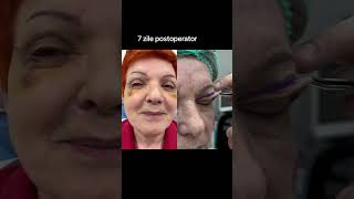 Blefaroplastie superioară operația de micșorare a pleoapelor căzute realizată la Clinica Dr Levy [upl. by Nwahc]