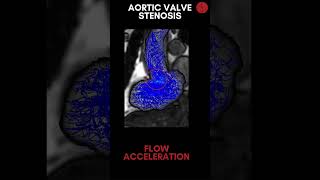 Aortic valve stenosis StreamLines [upl. by Even]