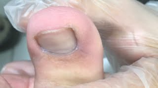 Thumb Swollen Treatment Paronychia [upl. by Riada]