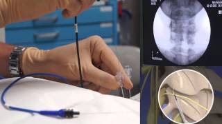 See why Radiofrequency Ablation RFA procedure is better than laser spine surgery [upl. by Anawahs]