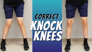 Top 5 Ways to Correct Knock Knees with Exercise Etc [upl. by Flori34]