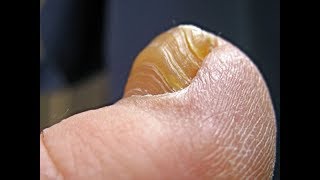 How to Cure Toenail Fungus Fast amp Naturally at Home [upl. by Wixted]