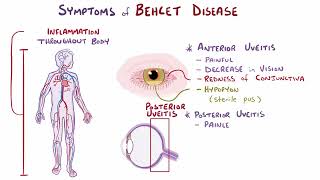 Behcet Disease  Osmosis [upl. by Christian889]