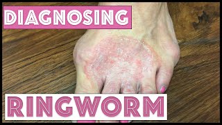 How we diagnose Ringworm Tinea Corporis [upl. by Tnomyar]