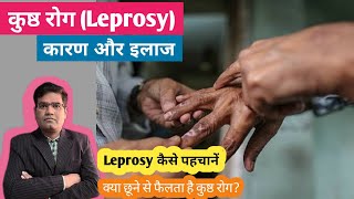 Leprosy कुष्ठ रोग Cause Symptoms and Treatment  लेप्रोसी के खतरे एवं बचाव [upl. by Oona]