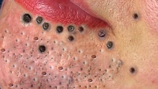 Big Cystic Acne Blackheads Extraction Blackheads amp Milia Whiteheads Removal Pimple Popping  4656 [upl. by Burwell]