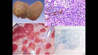 HEMOSIDEROSIS Y HEMOCROMATOSIS • FISIOPATOLOGIA MÉDICA [upl. by Orel179]