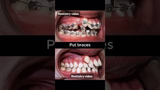 Braces are very crooked teeth braces orthodontist dentistry dentist allaboutbraces [upl. by Llydnek]