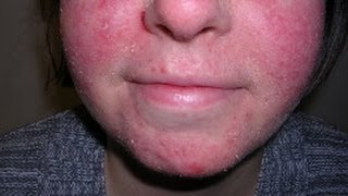 How to Treat Facial Eczema DermTVcom Epi 479 [upl. by Therron]