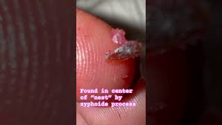 fungus spores mold skin flukes morgellons myjourney skin condition ulcer help share win [upl. by Tedmund212]