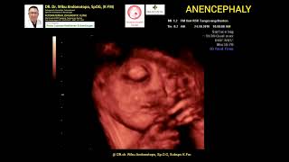 Anencephaly TM 3 [upl. by Serrano]