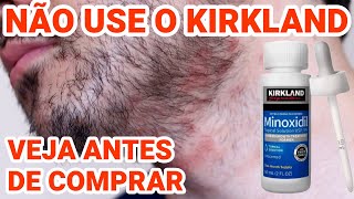 NÃO COMPRE MINOXIDIL KIRKLAND IMPORTADO  VEJA ANTES DE COMPRAR [upl. by Nevs]