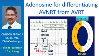 Adenosine for differentiating AVNRT from AVRT [upl. by Dichy505]