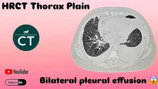 How to make filming  HRCT Thorax Plain  Ge 32 revolution [upl. by Anna-Maria417]