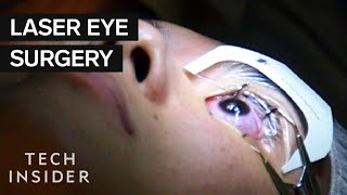 What Its Like To Get Laser Eye Surgery [upl. by Artema]