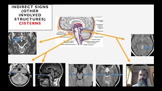 Brain herniation syndromes [upl. by Christiana]