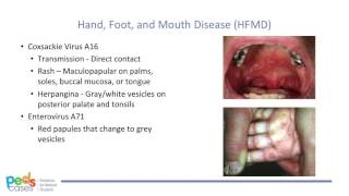 Viral Rashes in Children [upl. by Willette]