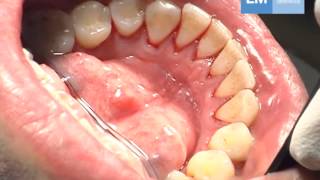 Periodontal treatment protocol [upl. by Yebba257]