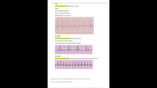 Relias Dysrhythmia Basic B Test 35 Questions and Answers 2023 [upl. by Erida698]