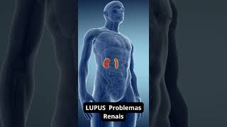 LUPUS Problemas Renais doencaautoimune doencasautoimune lupus [upl. by Alien113]