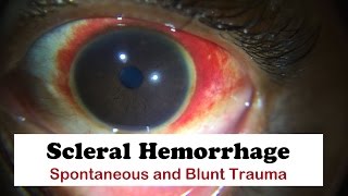 Scleral Hemorrhage [upl. by Haimrej]