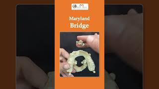 😱 Do You know How we placed Maryland Bridge ✨ maryland bridge dentalprocedure oramaxclinic yt [upl. by Nelson]