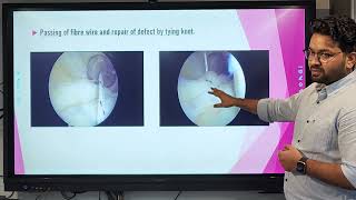 RAMP lesion of the knee  Arthroscopy repair with Posteromedial Approach [upl. by Selry618]