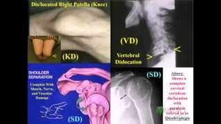 Knee Disarticulation [upl. by Aryas]