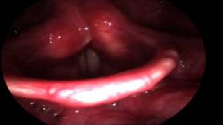 My Larynx  High Speed Video [upl. by Annaoy]